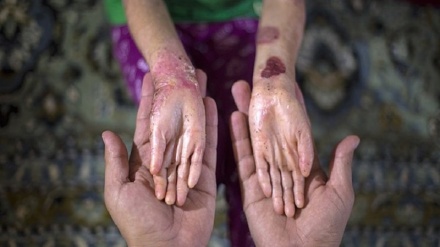 Problemet e fëmijëve me sëmundjen EB në Iran, rezultat i sanksioneve amerikane dhe sabotimit të Suedisë