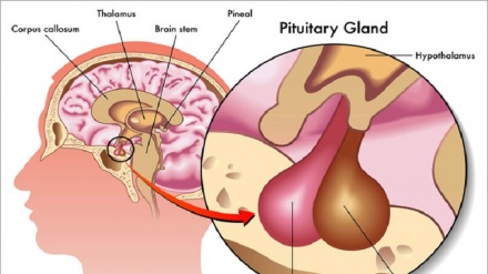 Безларнинг касалликлари ва бузилишлари, гипофиз безининг бузилиши, олтинчи қисм: гипофиз етишмовчилиги) сабаб ва даволаш)