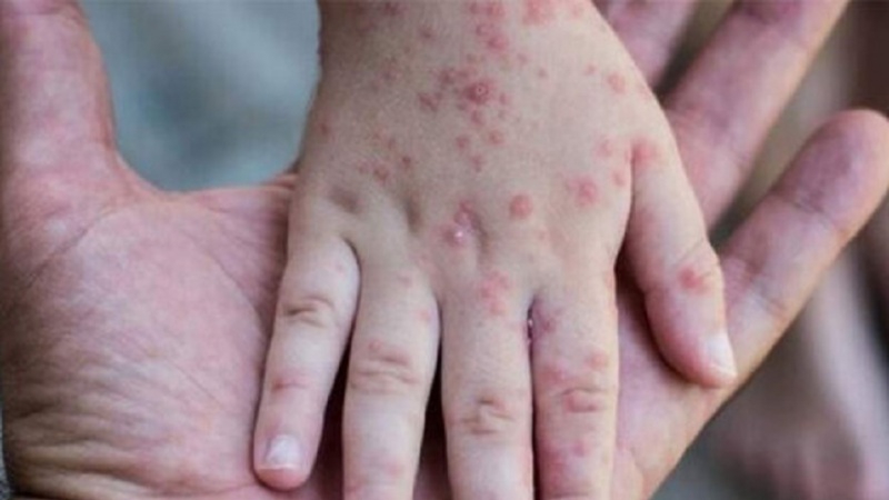 伊朗卫生 部长：世卫组织批准伊朗已消除麻疹和风疹