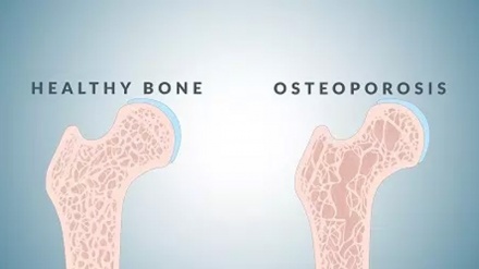 Скелет ва мушак касалликлари (остеопороз)