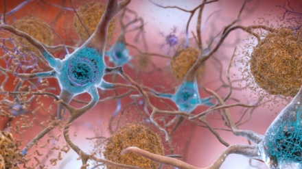 Alzheimer, un nuovo farmaco rallenta la malattia 