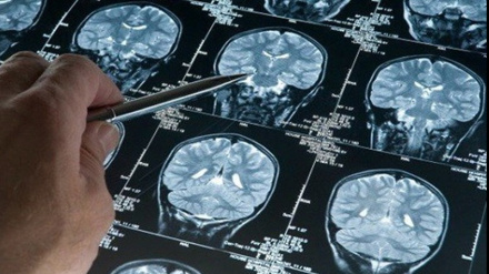 Иран на втором месте в мире по производству лекарств от инсульта