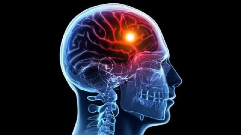آسیب خفیف به سر احتمال سکته مغزی را افزایش می‌دهد