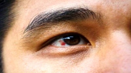 علت ایجاد لکه خون در چشم چیست؟