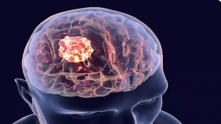 تحول در درمان سرطان مغز با دستگاهی بسیار کوچک