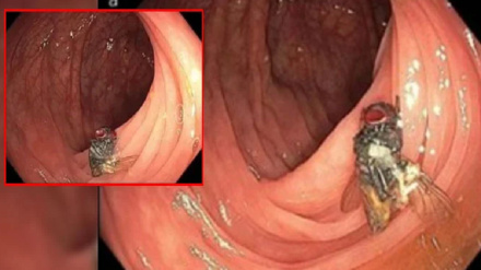 د بوډا سړي له  کولمو مچ راوویستل شو