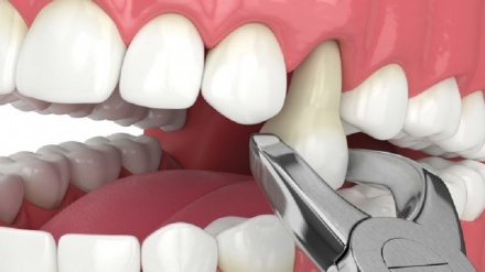 د ترکیې صفا کار د سړي څلور روغ غاښونه وویستل