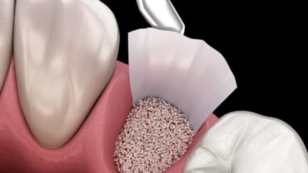 Иранские исследователи достигли технических знаний в области производства «костных строительных материалов»