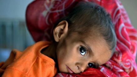 سه میلیون کودک در افغانستان به درمان تغذیه نیاز دارند