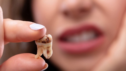 آشنایی با عوامل و چگونگی پوسیدگی دندان‌ها 