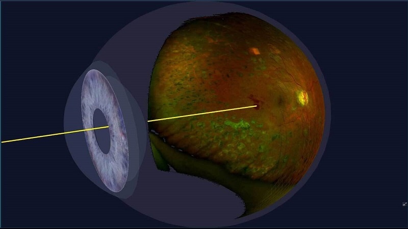 موفقیت محققان ایرانی در پیشگیری از نابینایی مبتلایان به عارضه ارثی شبکیه