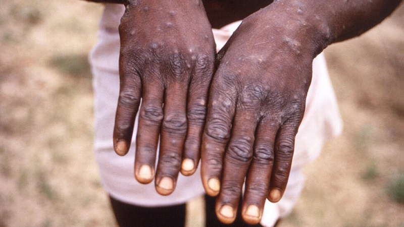 Maambukizo ya ugonjwa wa Mpox yaongezeka nchini Uganda