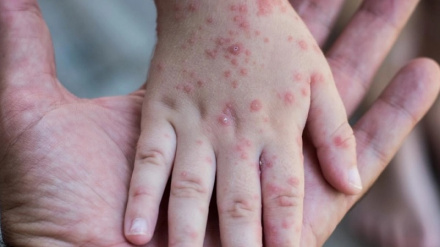 Umoja wa Ulaya wazitaka nchi wanachama kujiandaa na wimbi la MPOX
