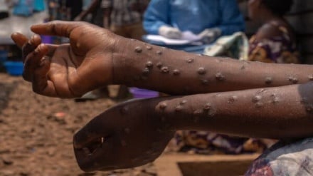 Togo yathibitisha kesi ya kwanza ya ugonjwa wa Mpox