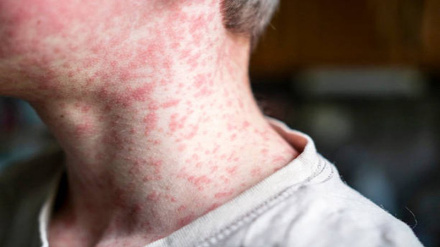 Zaidi ya watu 10,000 waambukizwa ugonjwa wa rubella Afrika Kusini