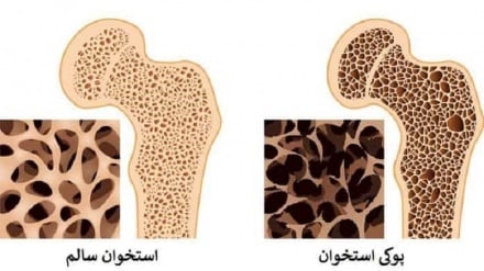 جلوگیری از پوکی استخوان با مصرف این میوه