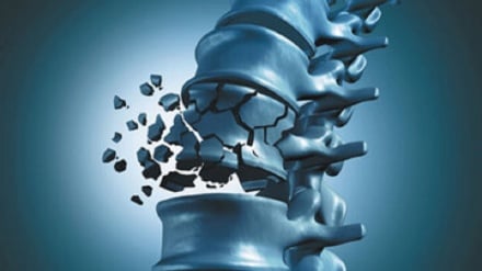 جلوگیری از پوکی استخوان با مصرف این میوه