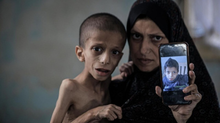 Şifa Hastanesi Müdürü: Gazze’deki çocuklar yaygın şekilde yetersiz beslenmeyle karşı karşıya  