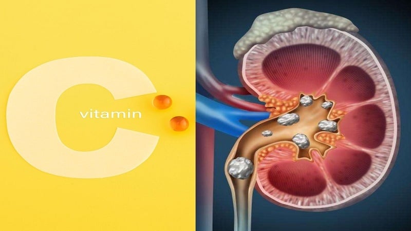 با مصرف زیاد این ویتامین، سنگ کلیه میگیرید