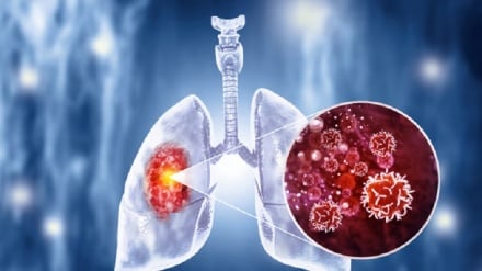 Utafiti: Pombe, Sigara vinachangia ongezeko la ugonjwa wa saratani Kenya