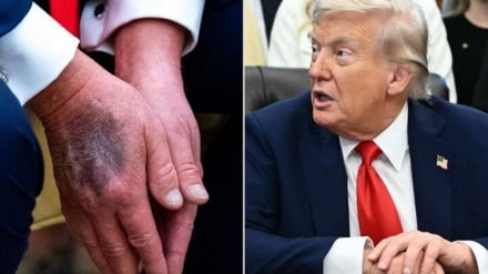 Tabibu wa viungo: Huenda Trump akawa amebakiwa na miaka 2 hadi 4 tu ya kuishi